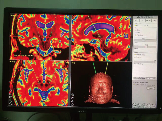 揚(yáng)州市首例帕金森病人植入腦起搏器順利完成